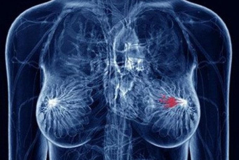 Как лечить рак груди