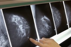 Виды рака молочной железы