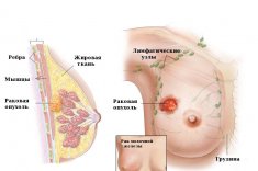 Таблетки от рака молочной железы