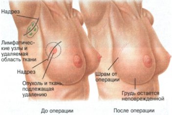 Профилактика рака молочной железы - No-onco.ru