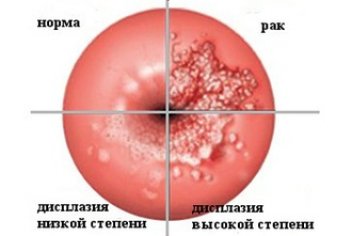 Инвазивный рак шейки матки - No-onco.ru