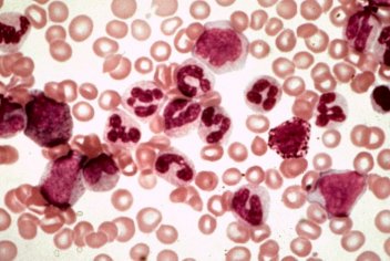 Лейкоз крови факторы возникновения классификация - No-onco.ru