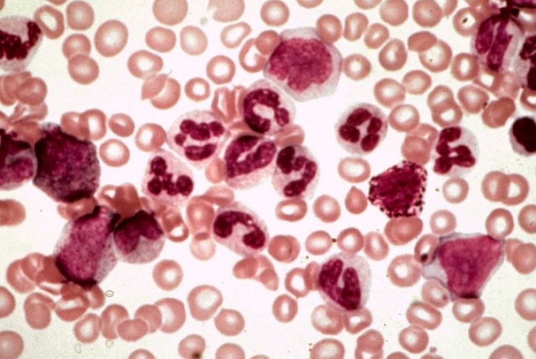Лейкоз крови факторы возникновения классификация