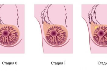 Классификация рака молочной железы - No-onco.ru