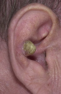 Плоскоклеточный рак уха