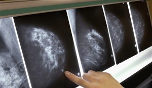 Снимок рака груди