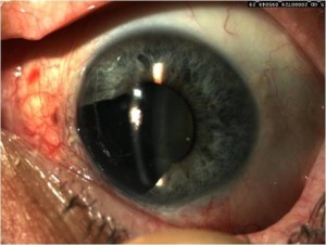 Меланома глаза 2-я стадия