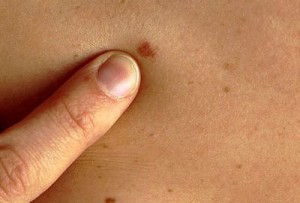 Рак кожи симптомы