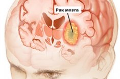 Стадии рака головного мозга
