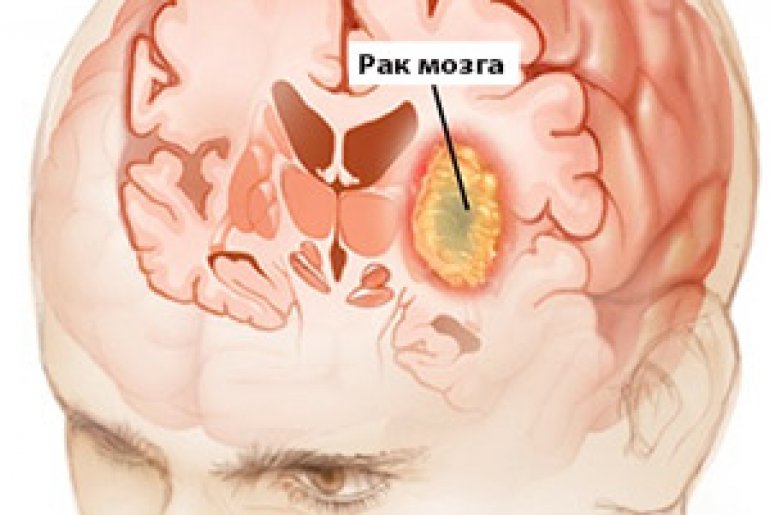 Стадии рака головного мозга