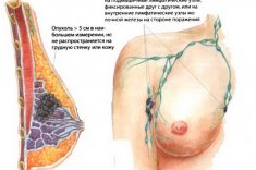 Метастазы молочной железы