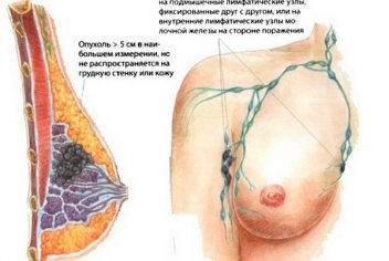 Метастазы молочной железы - No-onco.ru