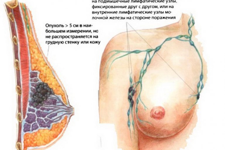 Метастазы молочной железы