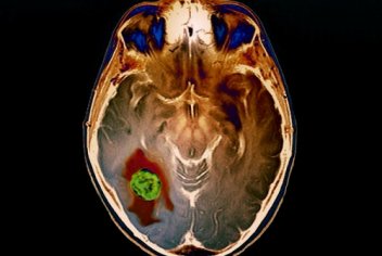 Головные боли при опухоли мозга - No-onco.ru