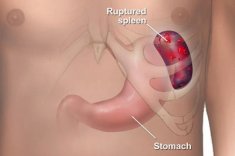 Рак селезенки симптомы прогноз