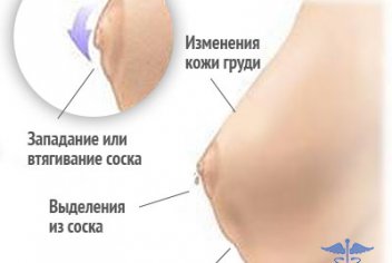 Рак груди как проявляется - No-onco.ru