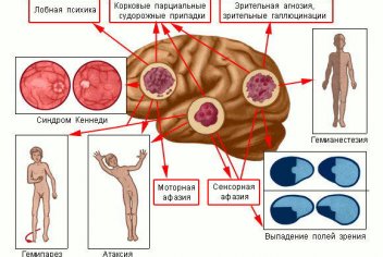 Диагностика рака головного мозга - No-onco.ru