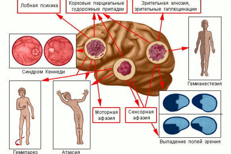 Диагностика рака головного мозга