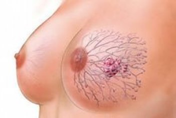 Лечение рака груди - No-onco.ru