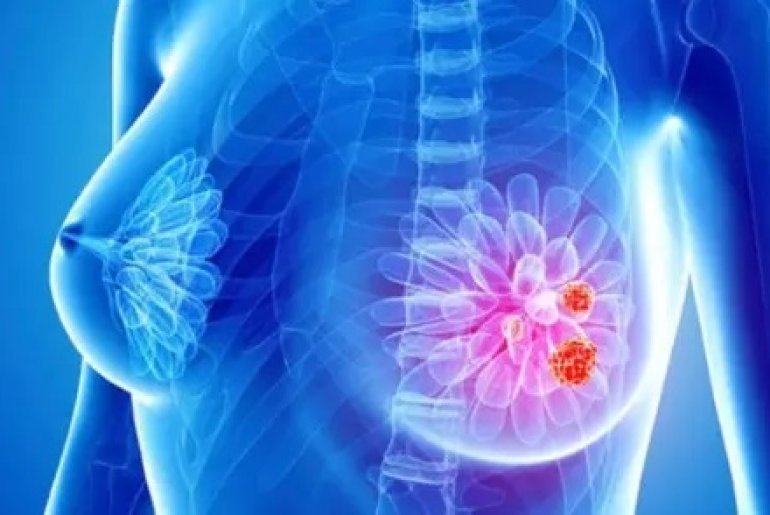 Новый тест определит риск рецидива рака груди