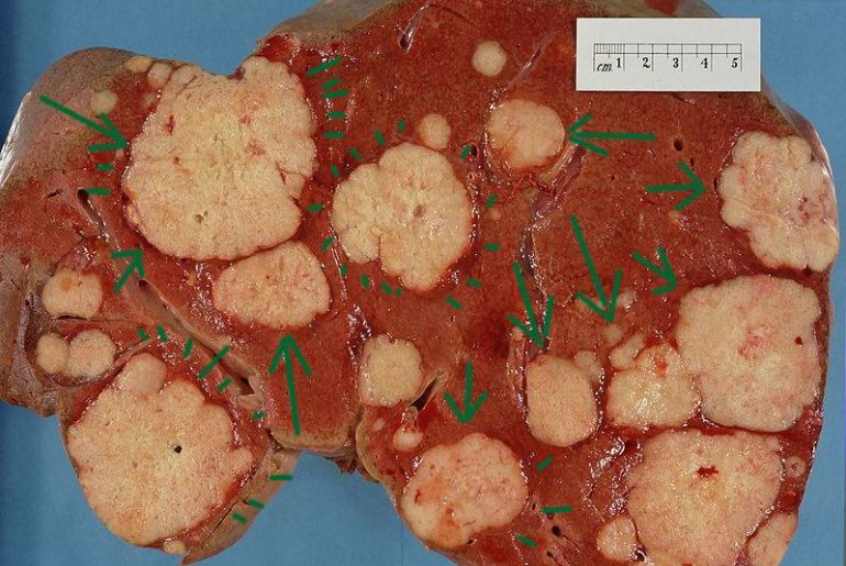 Метастазы в печени прогноз