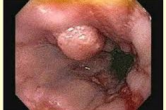 Плоскоклеточный рак гортани