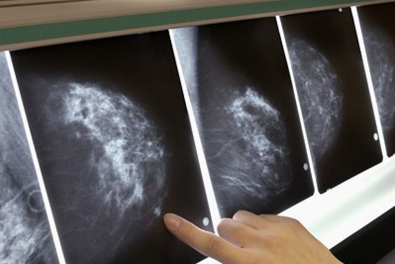 Виды рака молочной железы
