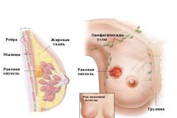 Таблетки от рака молочной железы - No-onco.ru