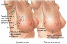 Профилактика рака молочной железы