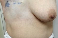 Удаление груди после рака