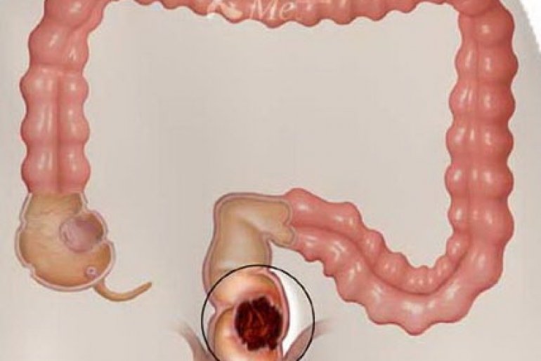 Рак толстой и прямой кишки причины признаки особенности диагностики