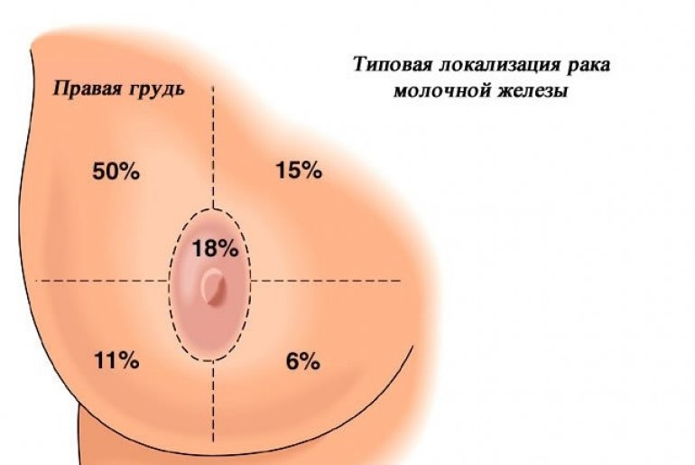 Рак молочной железы причины симптомы лечение