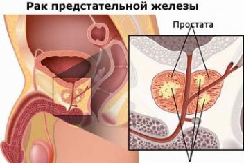 Диагностика рака простаты - No-onco.ru