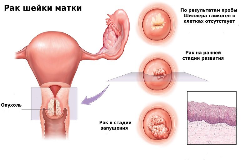 Бластома матки