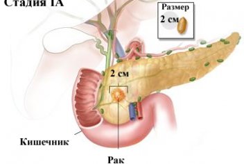 Опухоль поджелудочной железы - No-onco.ru