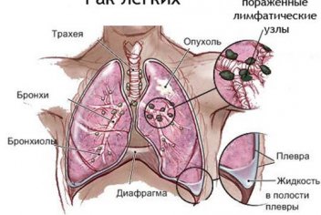 Рак левого лёгкого - No-onco.ru