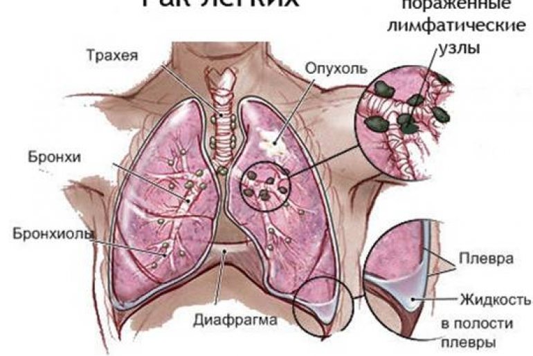Рак левого лёгкого