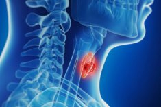 Рак щитовидной железы — симптомы у мужчин