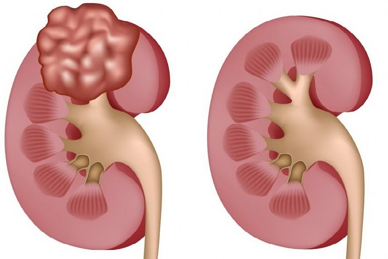 Светлоклеточная саркома почки