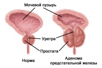 Профилактика аденомы простаты - No-onco.ru