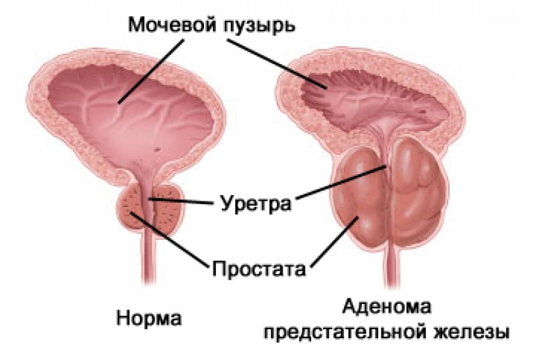 Профилактика аденомы простаты