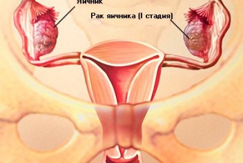 Лечение рака яичников - No-onco.ru