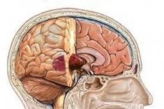 Удаление опухоли головного мозга