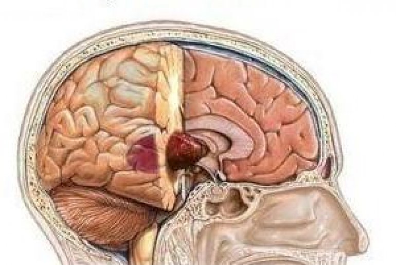 Удаление опухоли головного мозга
