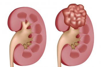 Рак почек описание и причины его возникновения - No-onco.ru
