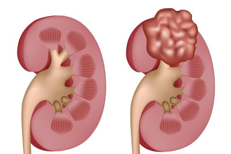 Рак почек описание и причины его возникновения