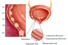 Переходно-клеточный рак мочевого пузыря