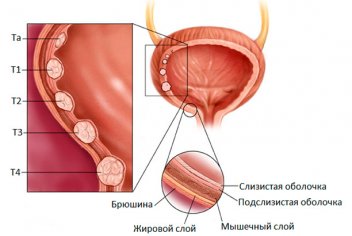Переходно-клеточный рак мочевого пузыря - No-onco.ru