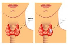 Диагностика рака щитовидной железы при помощи онкомаркера кальцитонина