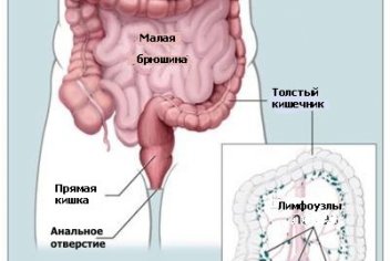 Рак кишечника различной локализации - No-onco.ru